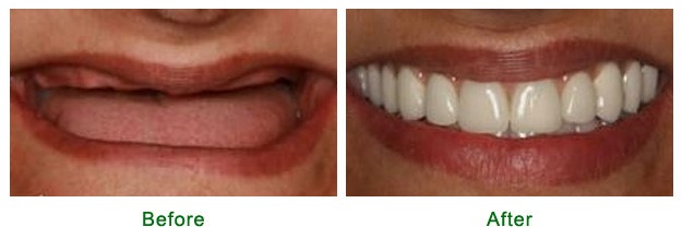 Young Dentures Before And After Atwood KS 67730